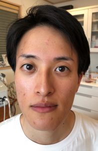 美容鍼 報告 男性バージョン 美容鍼 報告 男性バージョン